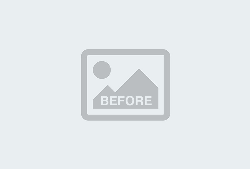 Before Image: Breast Implant Revision - front