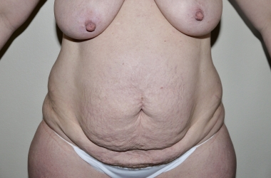 Before Image: Abdominoplasty - front