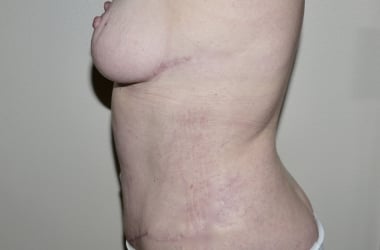 After Image: Abdominoplasty - left-side