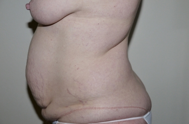 Before Image: Abdominoplasty - left-side