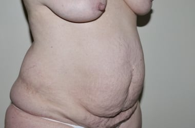 Before Image: Abdominoplasty - right-front-oblique