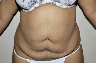 Before Image: Abdominoplasty - front