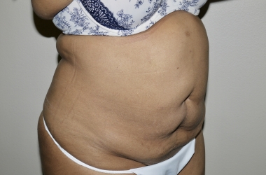 Before Image: Abdominoplasty - right-front-oblique