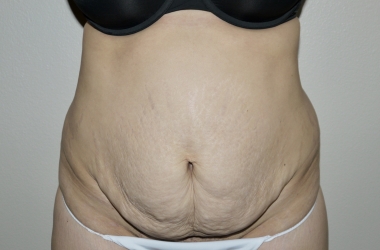 Before Image: Abdominoplasty - front