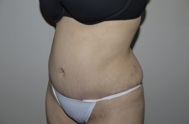 After Image: Abdominoplasty - left-front-oblique