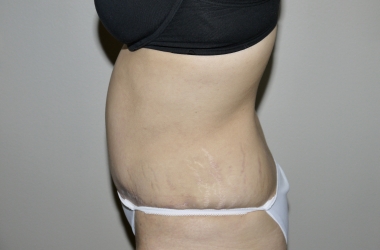 After Image: Abdominoplasty - left-side