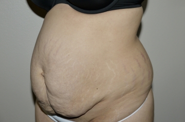 Before Image: Abdominoplasty - left-front-oblique