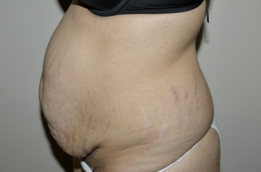 Before Image: Abdominoplasty - left-side