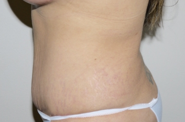 After Image: Abdominoplasty - left-side
