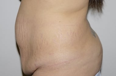 Before Image: Abdominoplasty - left-side
