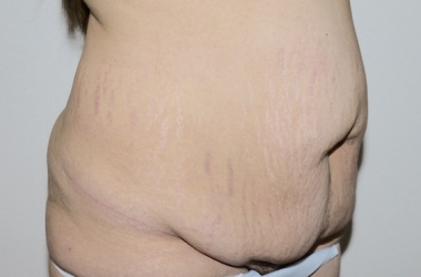 Before Image: Abdominoplasty - right-front-oblique