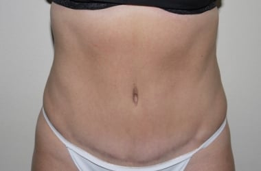 After Image: Abdominoplasty - front