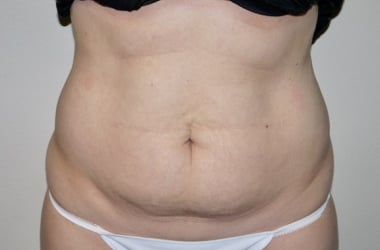Before Image: Abdominoplasty - front