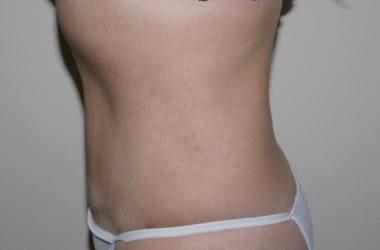 After Image: Abdominoplasty - left-side