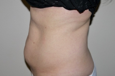 Before Image: Abdominoplasty - left-side