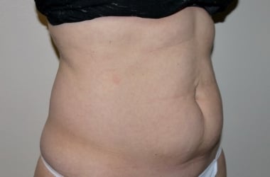 Before Image: Abdominoplasty - right-front-oblique