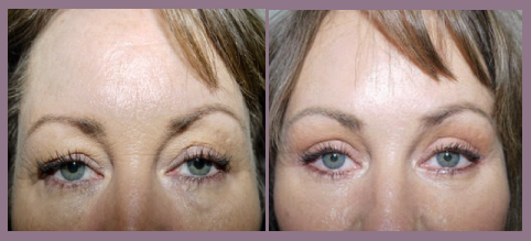 blepharoplasty las vegas before after 1