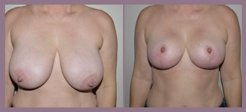 breast reduction before after las vegas