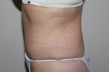After Image: Abdominoplasty - left-side