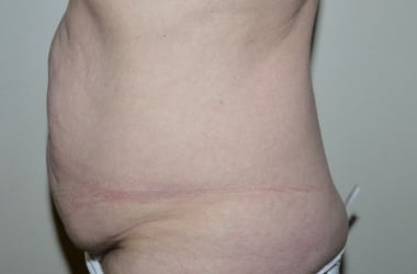 Before Image: Abdominoplasty - left-side