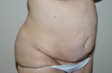 Before Image: Abdominoplasty - right-front-oblique