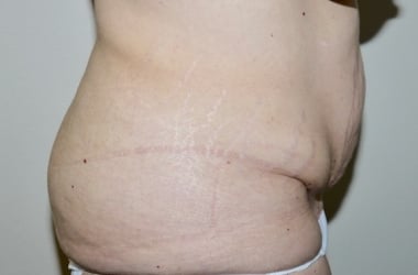 Before Image: Abdominoplasty - right-side