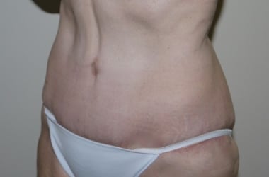 After Image: Abdominoplasty - left-front-oblique