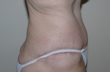 After Image: Abdominoplasty - right-side