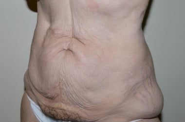 Before Image: Abdominoplasty - left-front-oblique