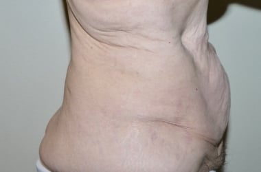 Before Image: Abdominoplasty - right-side
