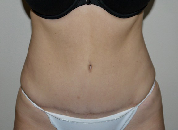 After Image: Abdominoplasty - front