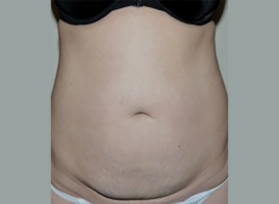 Before Image: Abdominoplasty - front