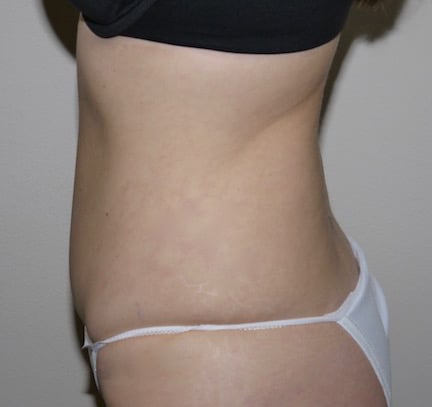 After Image: Abdominoplasty - left-side
