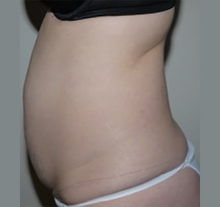 Before Image: Abdominoplasty - left-side