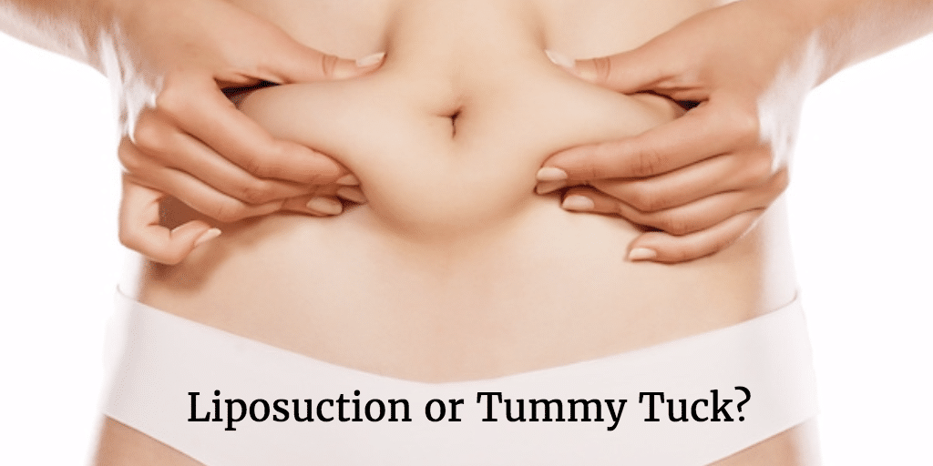 do i need liposuction or a tummy tuck 6414a829e8534