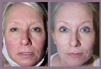 eyelid lift las vegas before after