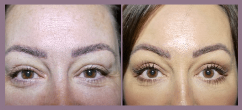 eyelid surgery before after 1