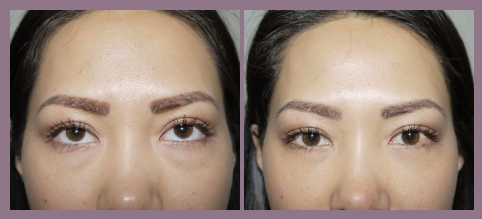 eyelid surgery las vegas