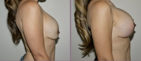 Breast Implant Removal