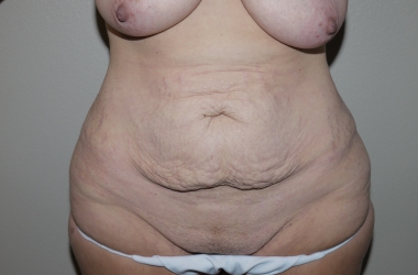 Before Image: Abdominoplasty - front