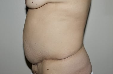 Before Image: Abdominoplasty - left-side