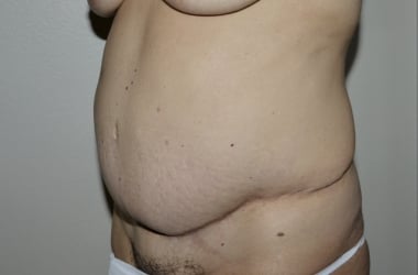 Before Image: Abdominoplasty - left-front-oblique
