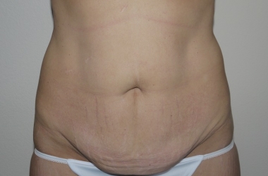 Before Image: Abdominoplasty - front