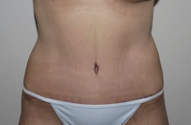 After Image: Abdominoplasty - front