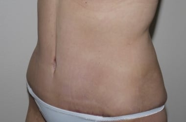 After Image: Abdominoplasty - left-front-oblique