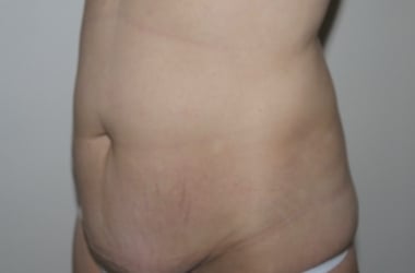 Before Image: Abdominoplasty - left-front-oblique