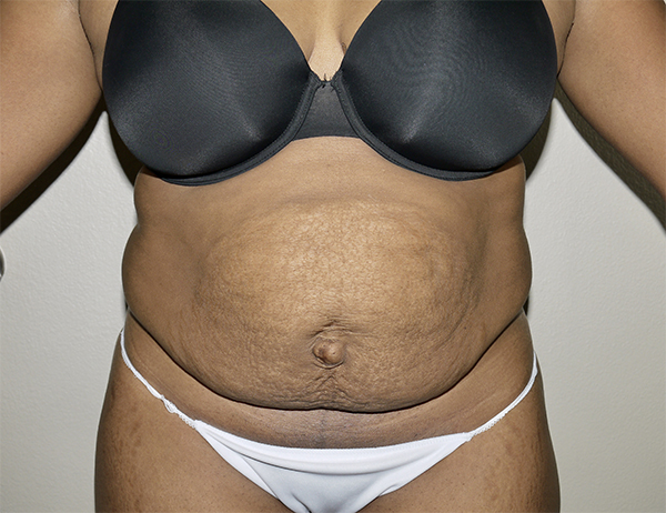 Before Image: Abdominoplasty - front