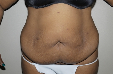 Before Image: Abdominoplasty - front