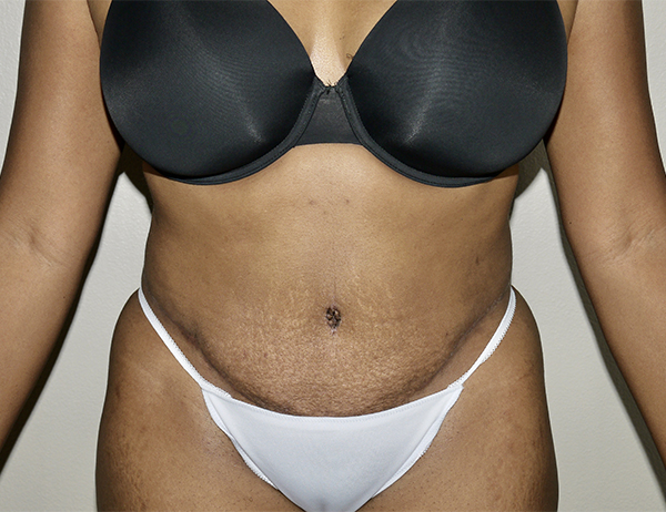 After Image: Abdominoplasty - front