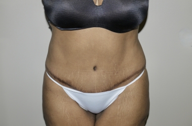After Image: Abdominoplasty - front